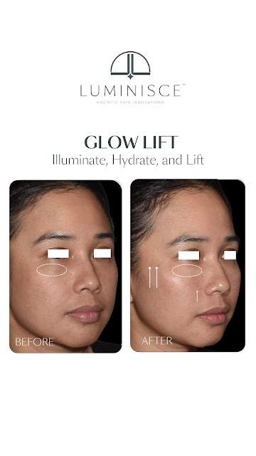 Luminisce Introduces Teoxane’s Glowing Lift: A New Era in Non-Surgical Facelifts